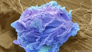 qelize kanceri